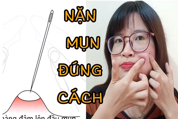 Nặn mụn đúng cách tại nhà