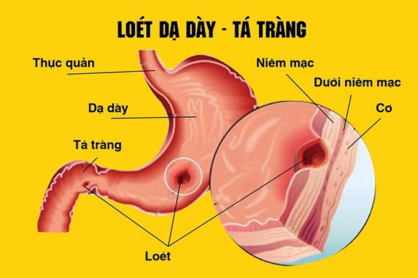 viem-loet-da-day-ta-trang